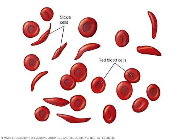 New Partnership Launched To Improve Sickle Cell Disease Care In Sub-Saharan Africa
